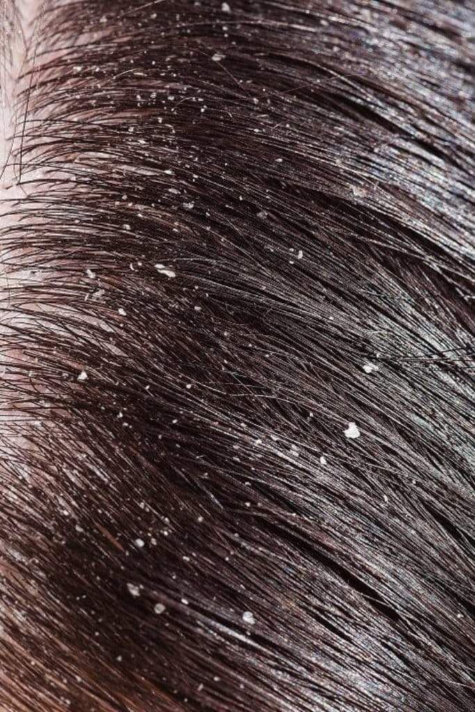 Keratin treatment and dandruff. Whether there is a connection between them? - Nutree Cosmetics